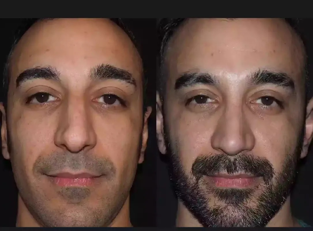 best male rhinoplasty