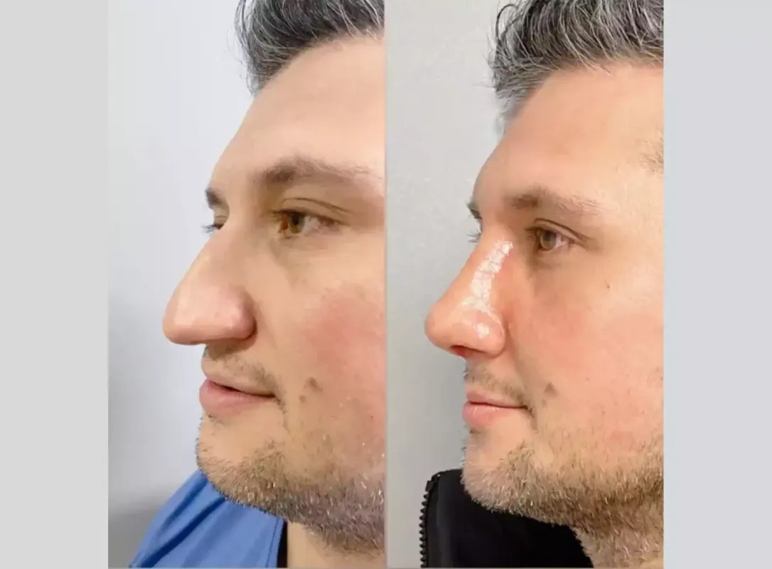 The Art of Rhinoplasty: Balancing Aesthetics and Functionality